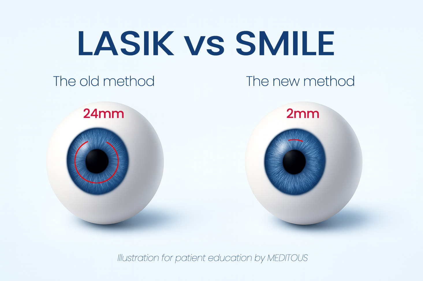 smile lasik